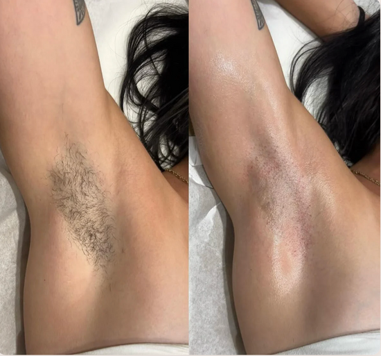 Bikini Pain-Free Hair Removal Cream for Sensitive Skin